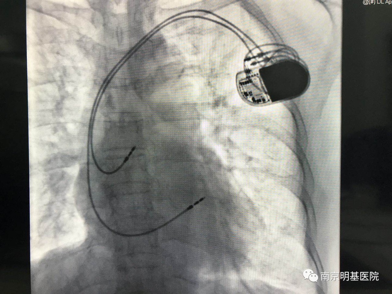 心臟起搏器置入術,手術很順利,李新主任成功為王奶奶安裝了一顆抗核磁