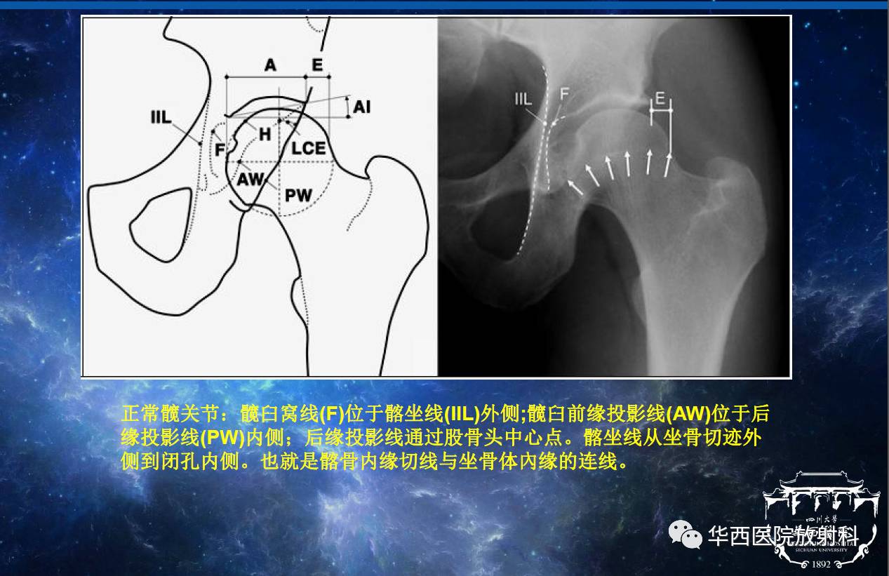 華西放射科深度業務學習系列之三十四髖關節撞擊綜合徵