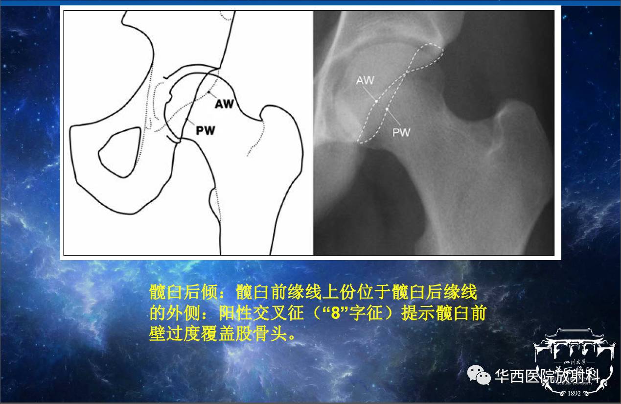 華西放射科深度業務學習系列之三十四髖關節撞擊綜合徵