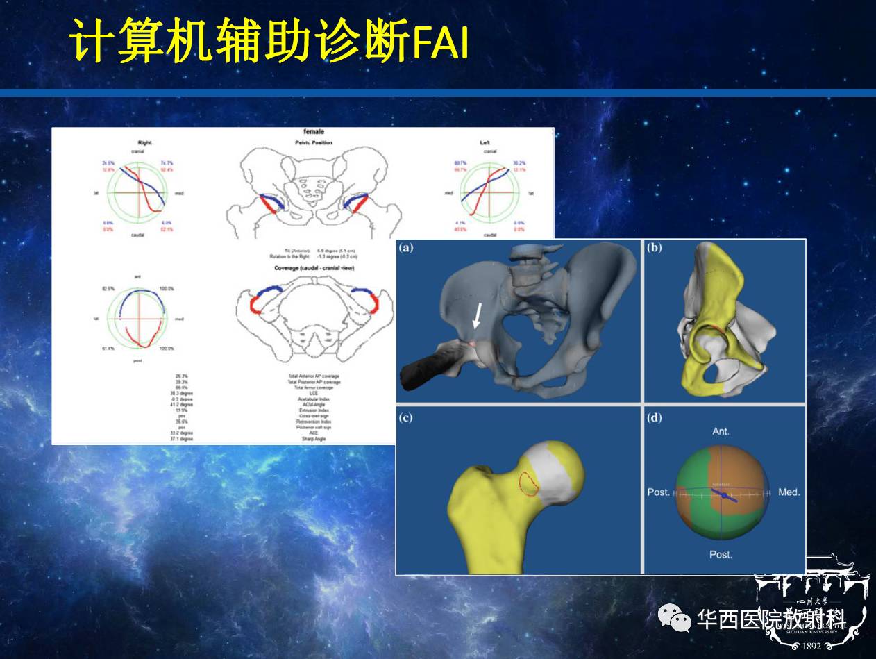 3,mri:可直接顯示髖臼唇和關節軟骨的損傷mr髖關節造影:能準確顯示fai