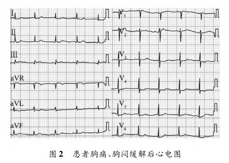 前降支心肌桥疑致急性心肌梗死一例