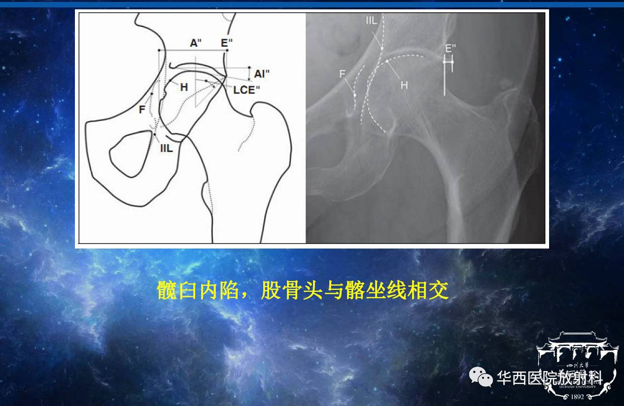 2,ct:较x线更直观地显示股骨近端,髋臼盂缘的骨性解剖异常能显示更
