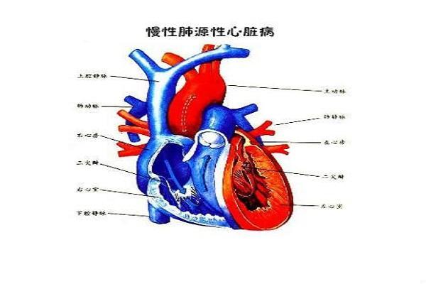 肺心病图解图片