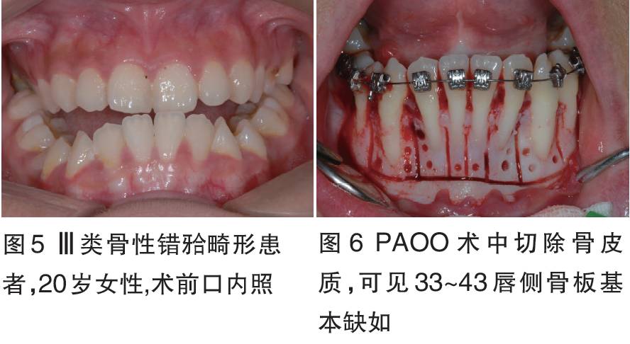 附着龈增宽术图解图片