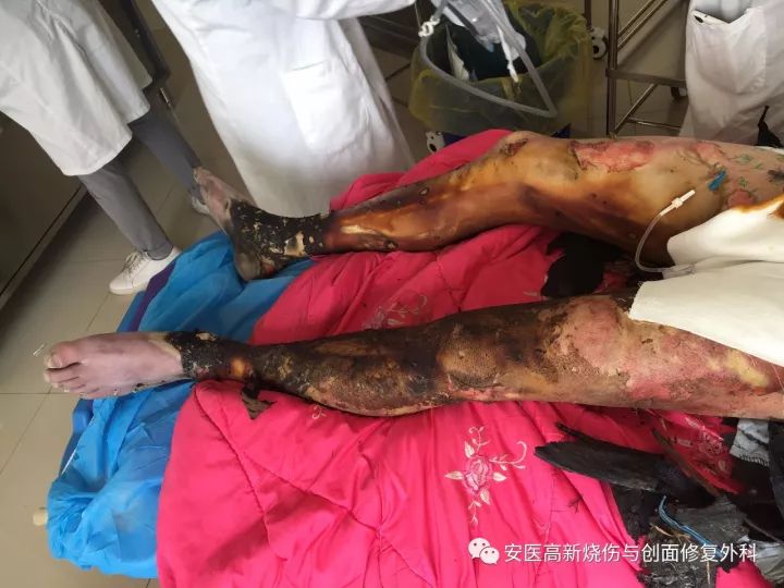 搶救一高壓電燒傷80合併外傷性脾破裂腎臟損傷和重度失血性休克患者