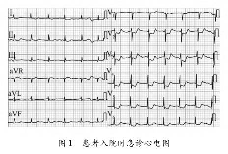 前降支心肌桥疑致急性心肌梗死一例