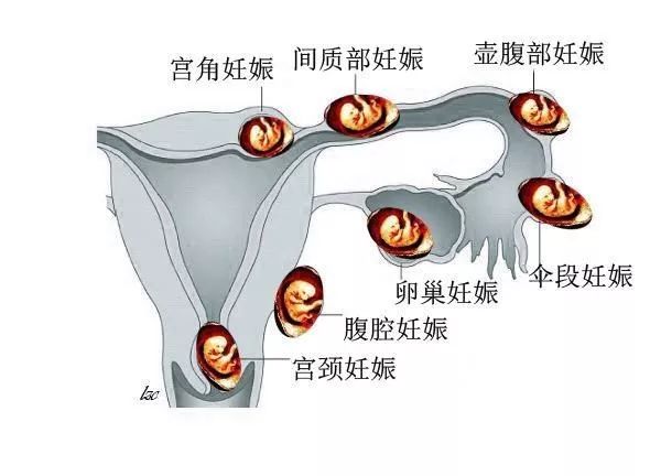 间质部妊娠图片