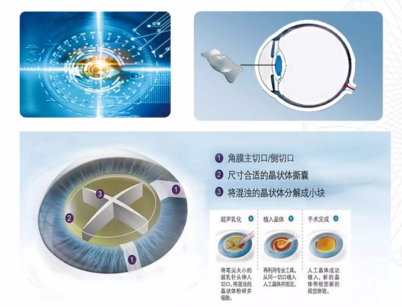 飛秒激光應用在白內障手術領域是一項