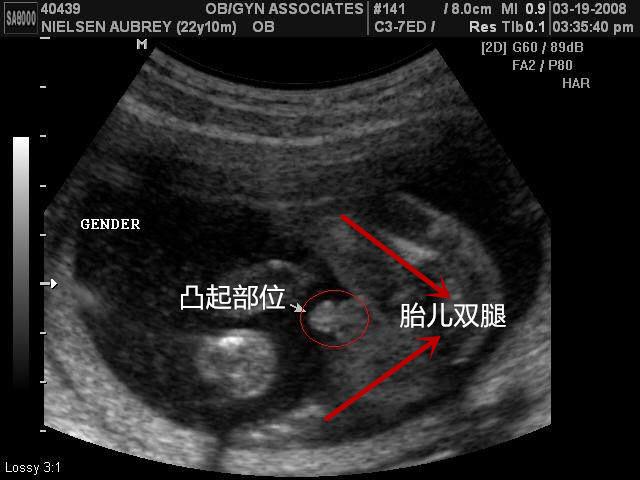 孕16周胎儿女孩彩超图图片