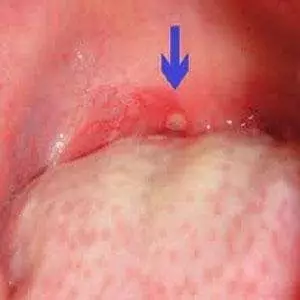 疱疹性咽峡炎的症状图图片