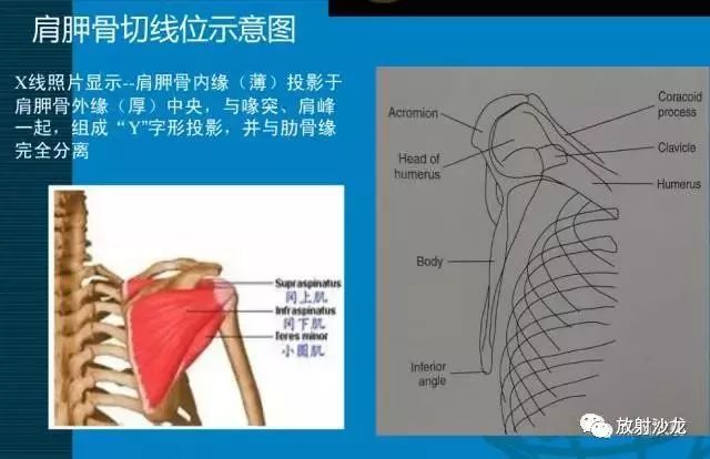 先來了解一下,岡上肌的位置(紅色),