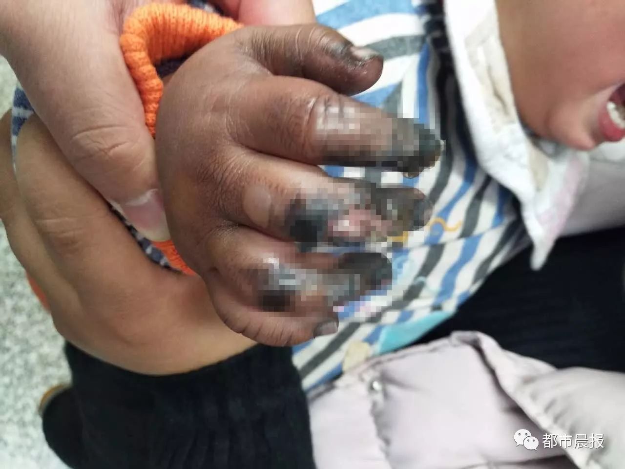 徐州一个周岁大的孩子,手指被灼伤焦黑!只因碰了电动车的这里