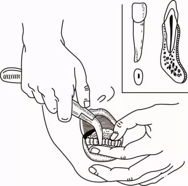 下颌67拔牙钳图解图片