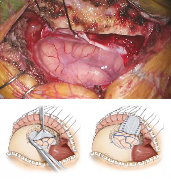 开颅手术的图片全过程图片