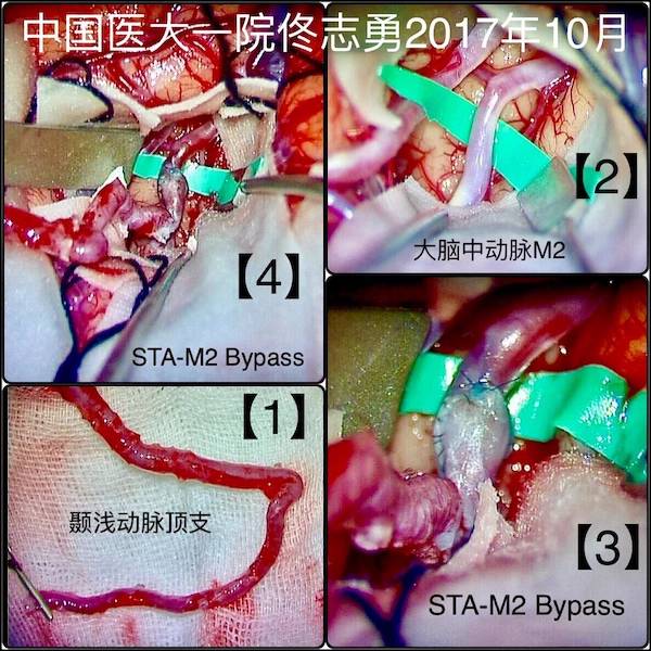 科技 正文(1)煙霧病; (2)需要阻斷腦血管的動脈瘤或頭頸部腫瘤; (3)