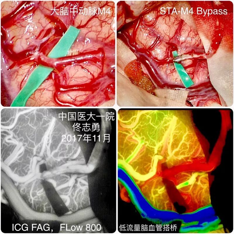 (5)移植血管腦動脈間置術:將顳淺動脈,枕動脈,小隱靜脈,顳上靜脈梃 