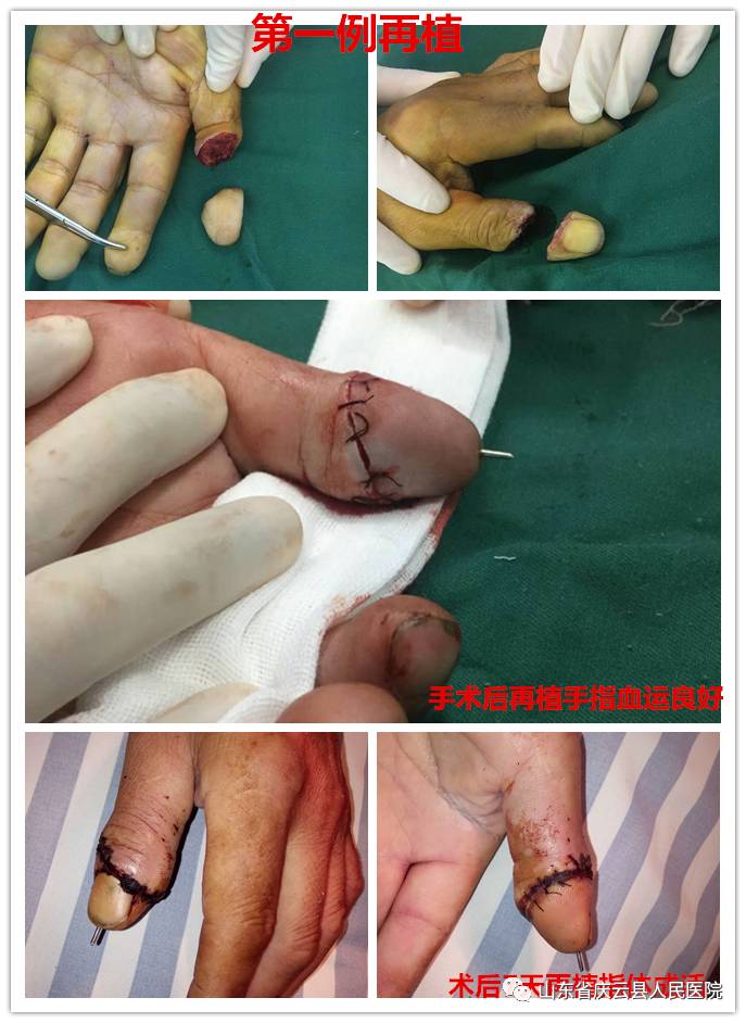 庆云县人民医院成功完成两例拇指末节离断再植手术