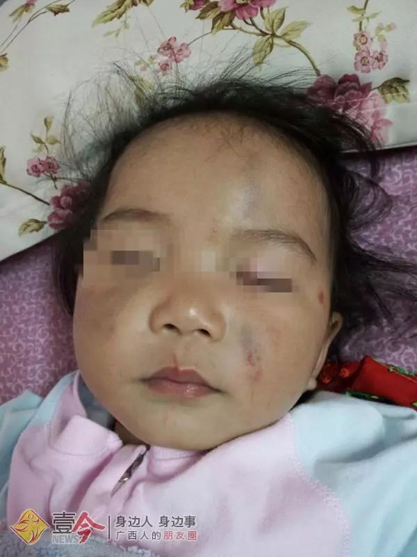 来宾一女童在幼儿园受伤却被校方要求退学,教育局:管不了