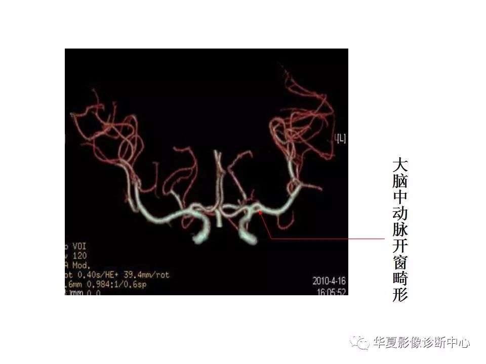 头颈部CTA解剖图谱图片