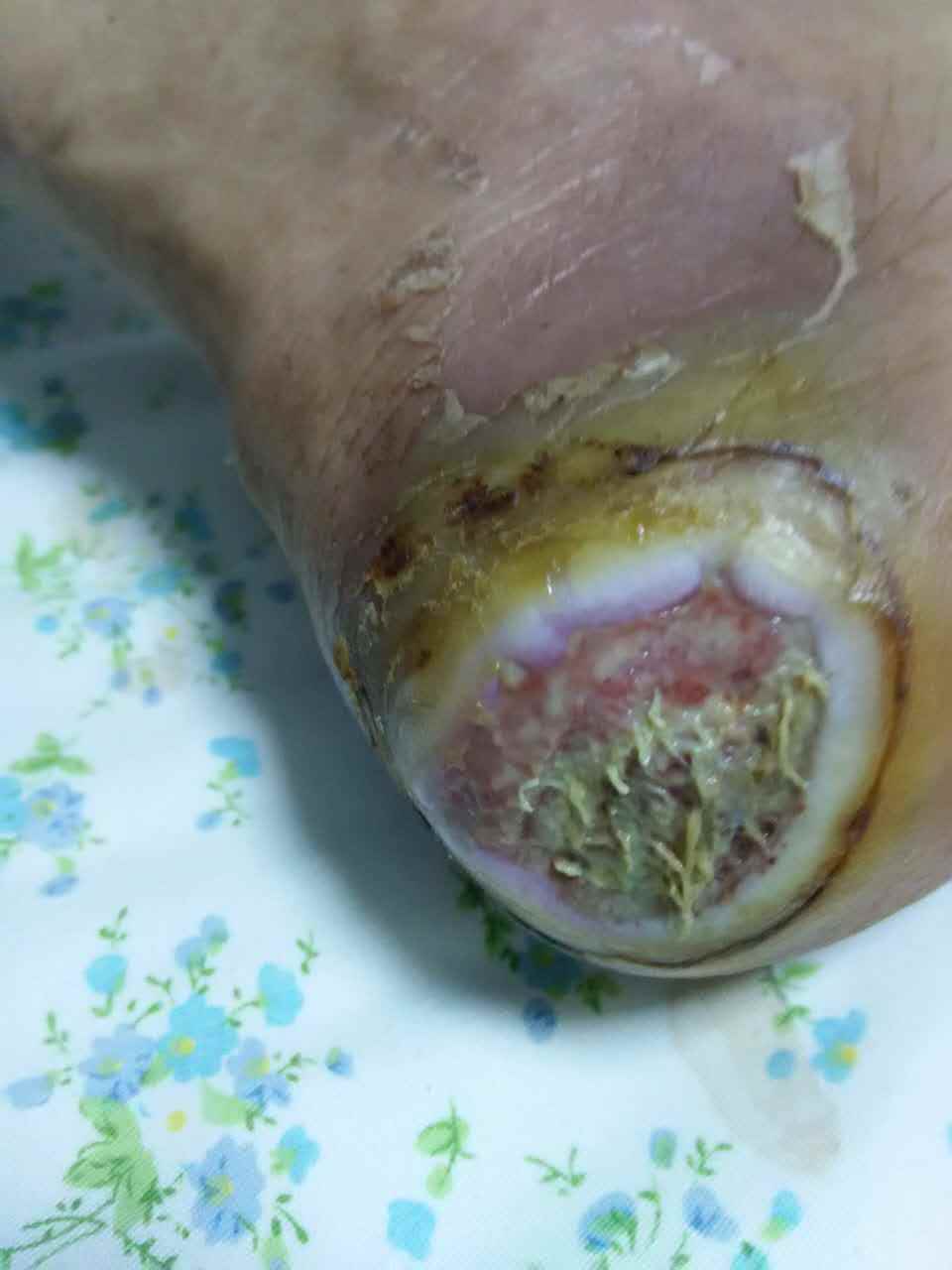 糖尿病人的脚烂的图片图片