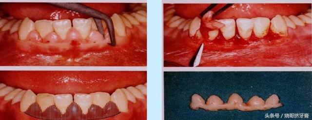 牙龈切除手术图解图片