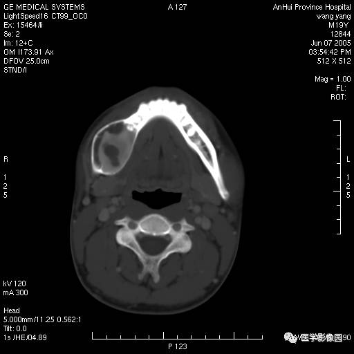 第八章骨骼與軟組織第二節骨腫瘤二良性腫瘤四骨化性纖維瘤丨精品連載