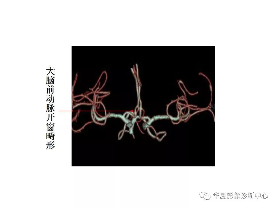 头颅血管cta解剖图谱ppt图片