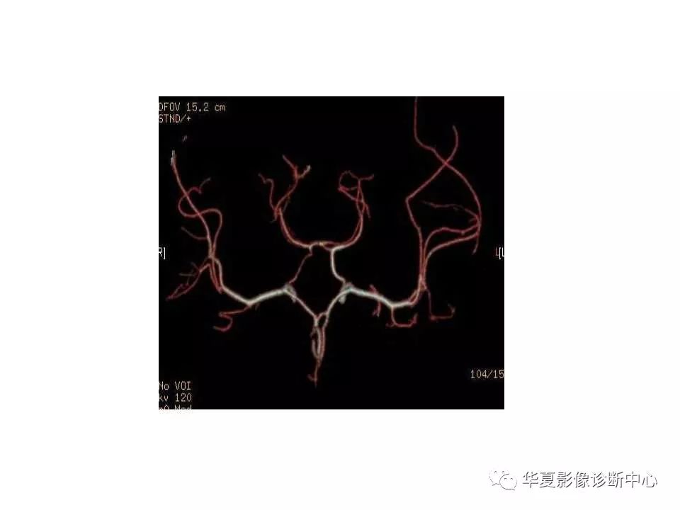 头颅血管cta解剖图谱ppt图片