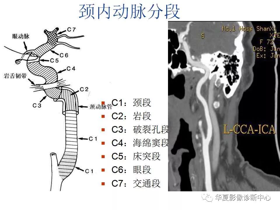 头颈部cta解剖图片图片