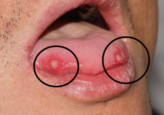 口腔溃疡很普遍,变成口腔癌还觉得普遍吗?