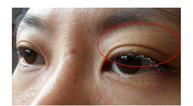 隆林人一旦眼睛出现这8种症状要当心,这可能是大病的征兆
