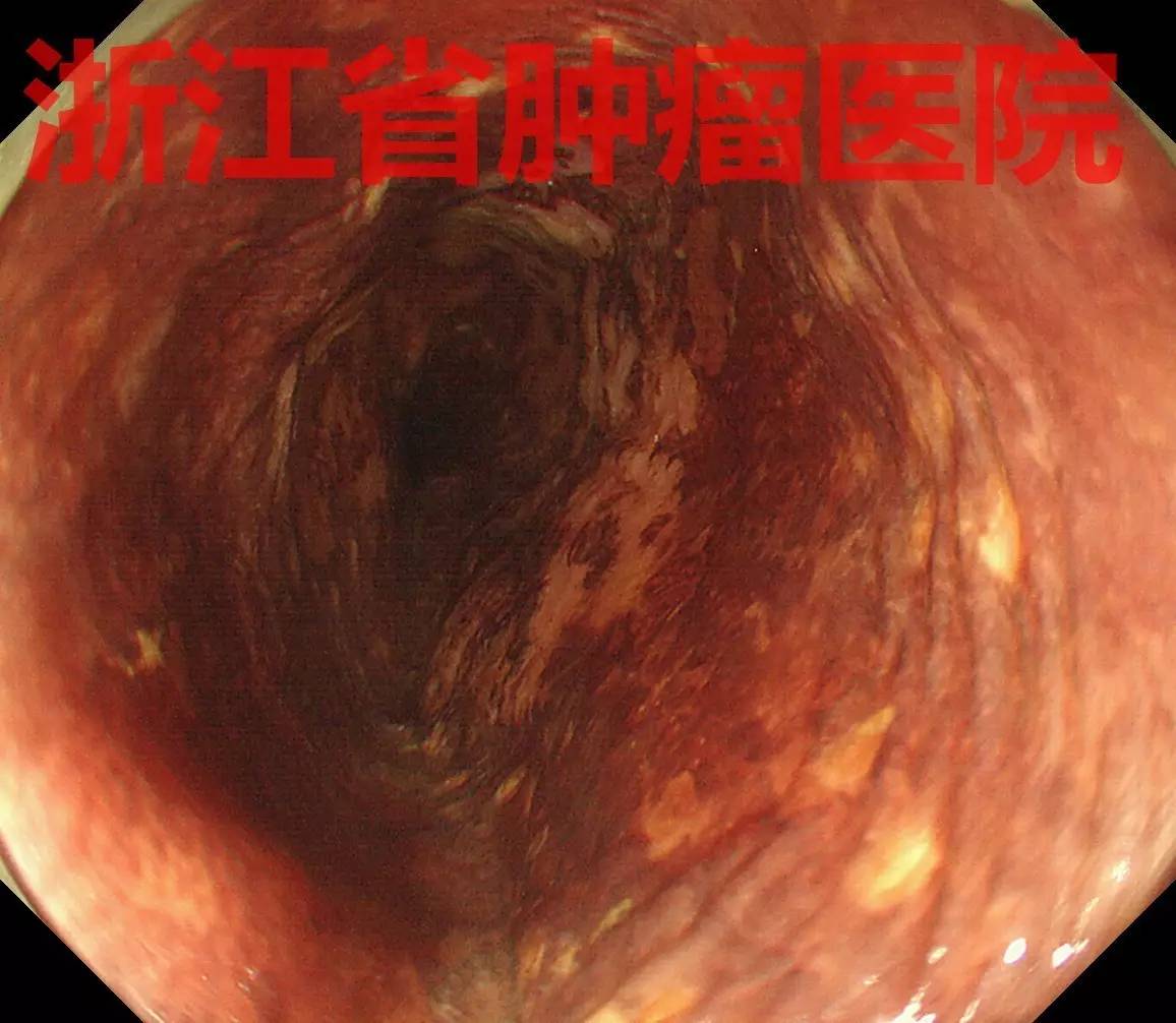 食管大面積黏膜病變,看看這家醫院如何處理?