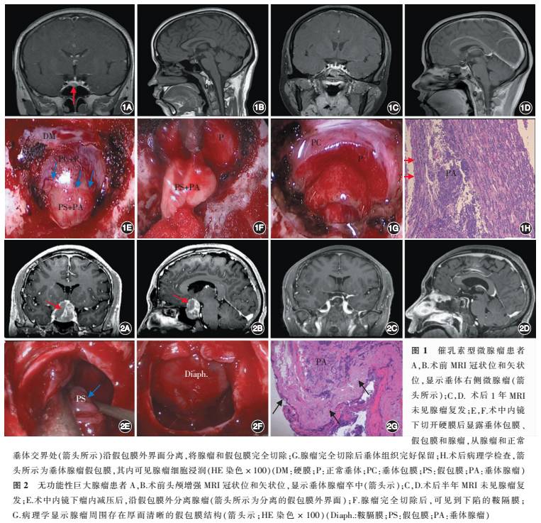假包膜外分离技术在神经内镜经鼻蝶垂体腺瘤切除术中的应用丨中华神外