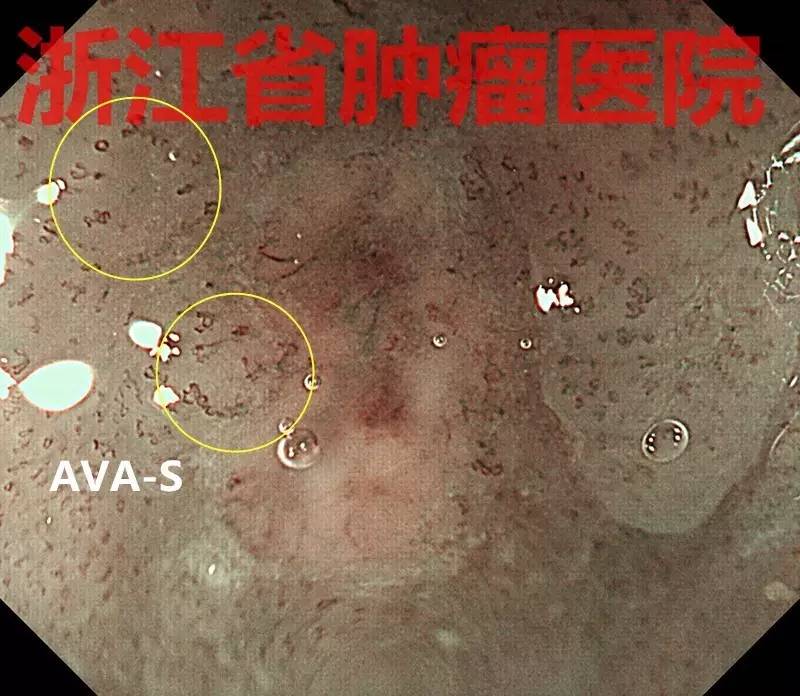 食管大面積黏膜病變,看看這家醫院如何處理?