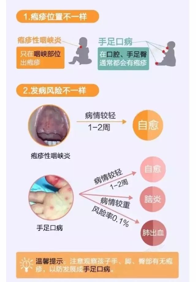 手足口病的兄弟皰疹性咽峽炎又到高發季它比手足口病還兇殘