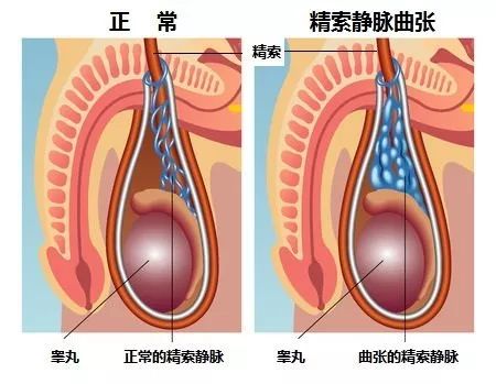 男童阴囊一侧肿大图片