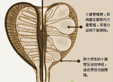 如果出現尿頻夜尿多尿等待尿不盡等可能是前列腺增生