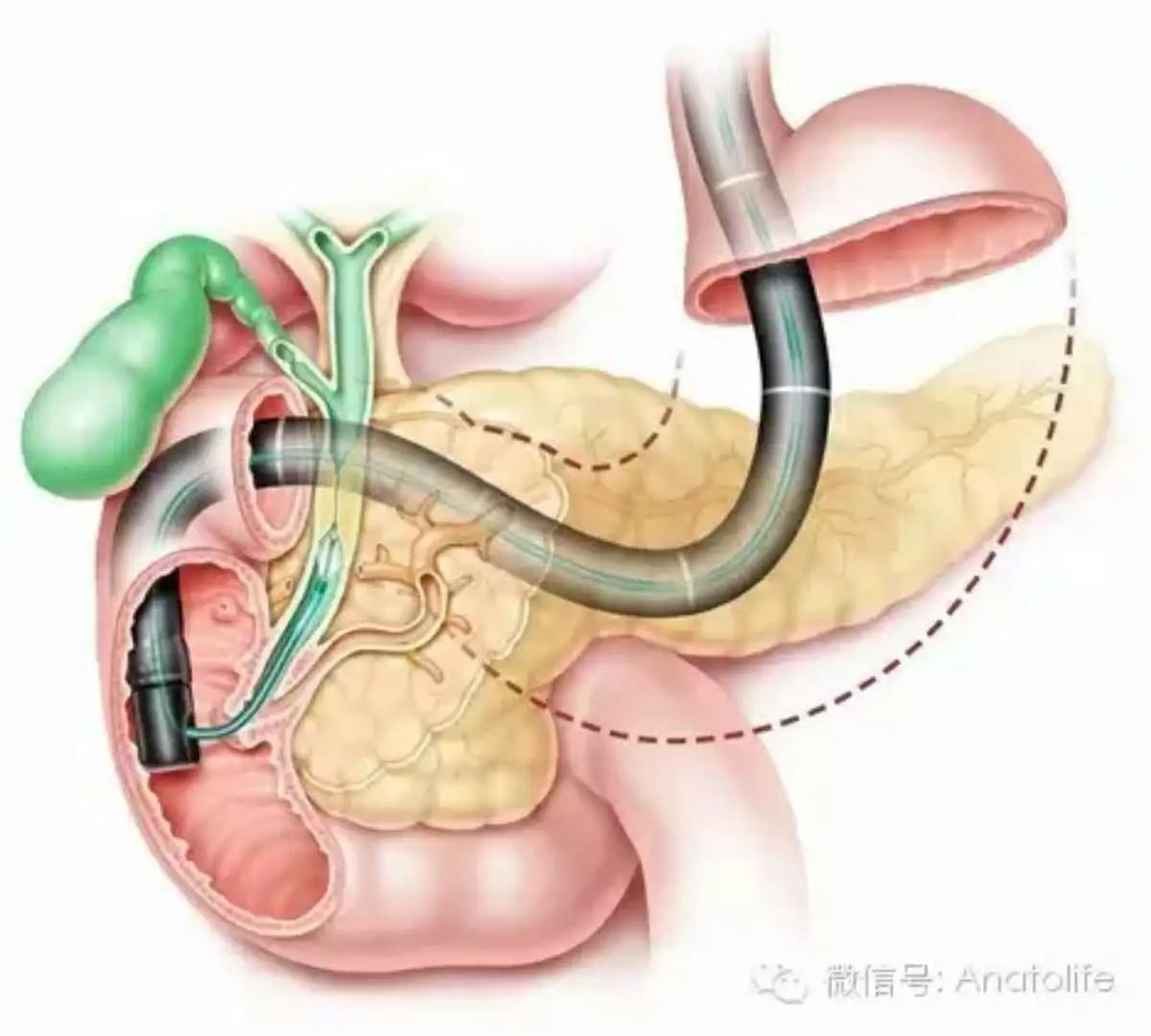 請您關注膽管膽囊結石鏡下除朱大媽心裡樂開花