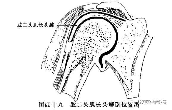 每日一例肱二頭肌長頭肌腱炎