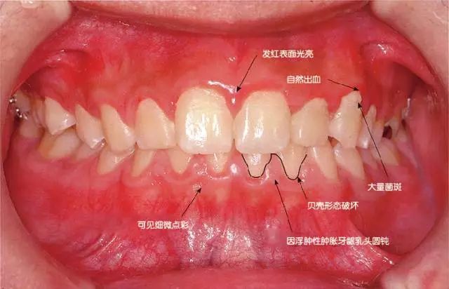 患牙龈炎的牙周组织的临床图像及说明患牙龈炎如采取适当治疗是可以