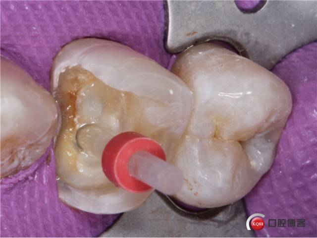 嵌體修復真的那麼簡單一例前磨牙修復遇到的各種坑