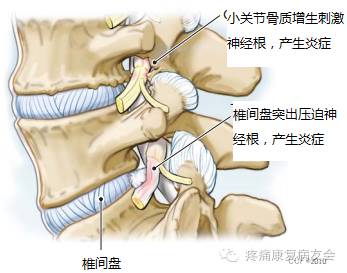 腰椎硬膜外腔注射介绍