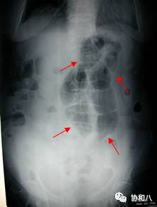 腹如刀絞何以辨液平腸袢助君識腸梗阻的識別和鑑別診斷一頁手冊協和八