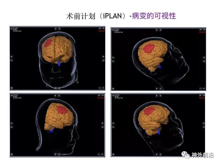 [演讲]天坛医院周大彪 胶质瘤手术应该如何选择影像引导技术 天坛