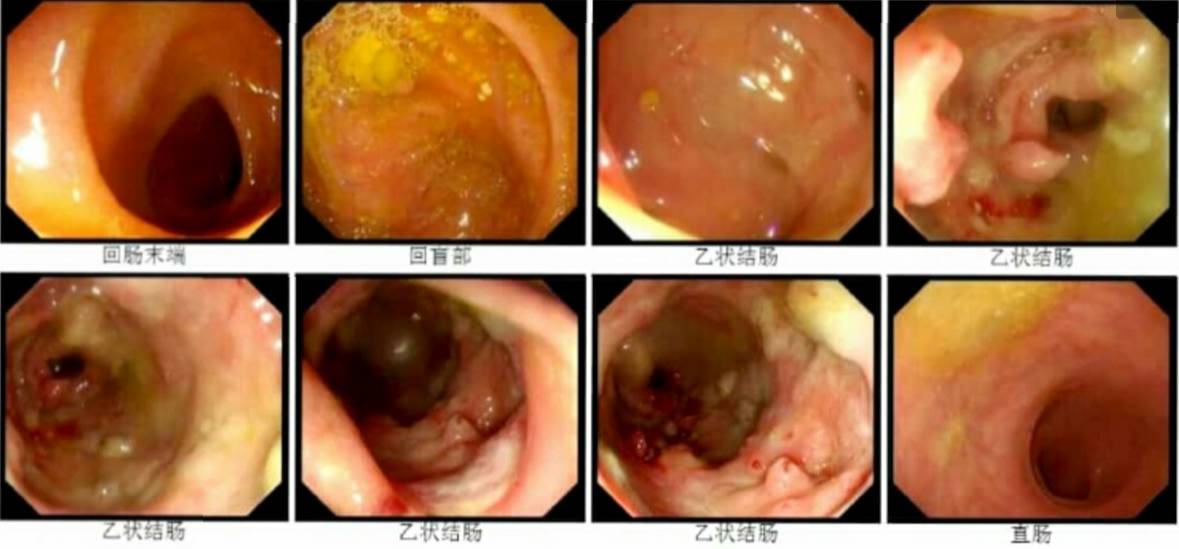 第二次病理結果病理提示潰瘍性炎,伴局灶腺體腺瘤樣增生,肉芽組織