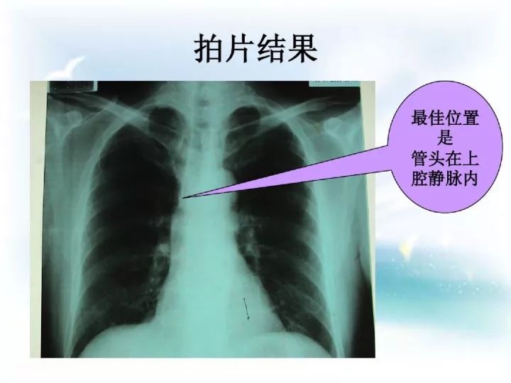 picc置管胸片正确位置图片