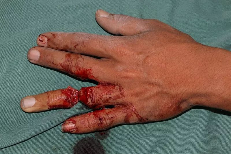 手指软组织挫伤图片