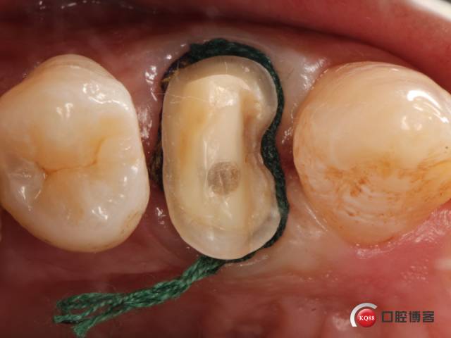 嵌體修復真的那麼簡單一例前磨牙修復遇到的各種坑