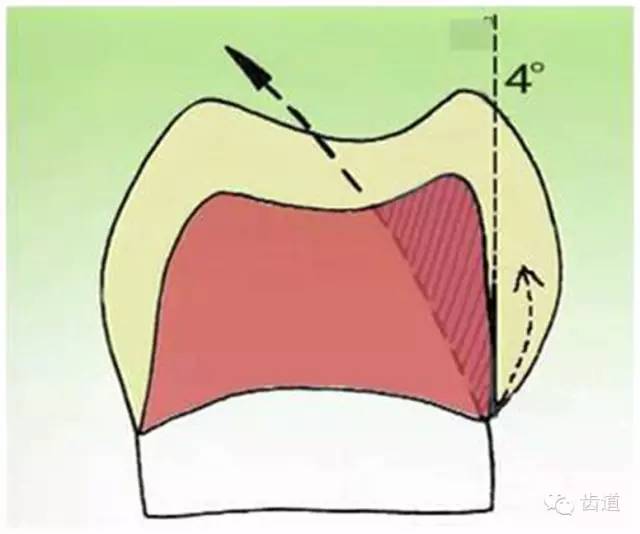 牙体预备聚合度图解图片