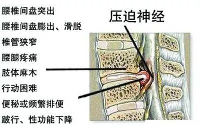 腰间盘突出,椎管狭窄,腰椎滑脱 3病合一 我可咋办呀?